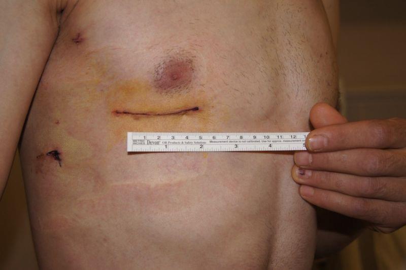 Mitral Valve Replacement in Turkey, MVR in Turkey, Mitral Valve Repair in Turkey