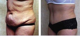 BODY CONTOURING - Plastic and Reconstructive Surgery