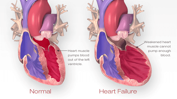 Kalp Yetmezliğinde EECP Tedavisi