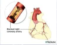 ATHEROSCLEROSIS - Cardiology