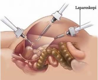 Laparoskopik cerrahi nedir? Laparoskopik cerrahi nedir?