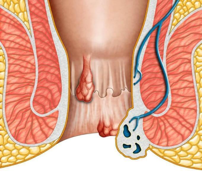 Hemoroid Nedir? Hemoroid Nedir?
