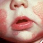 ​Eczema in Babies