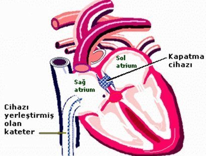 Doğumsal Kalp Hastalıkları