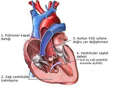 Doğumsal Kalp Hastalıkları