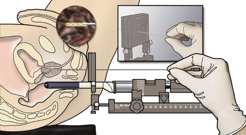 MR Fusion Prostate Biopsy