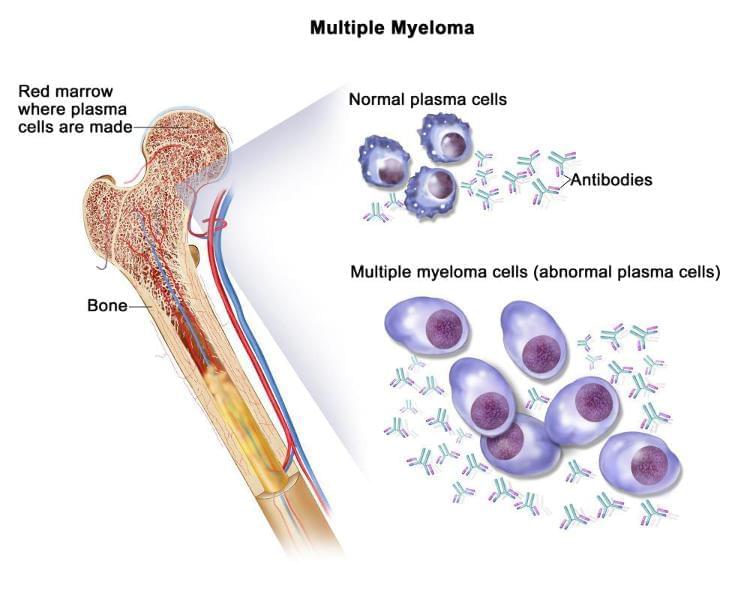 MULTİPLE MYELOMA MULTİPLE MYELOMA
