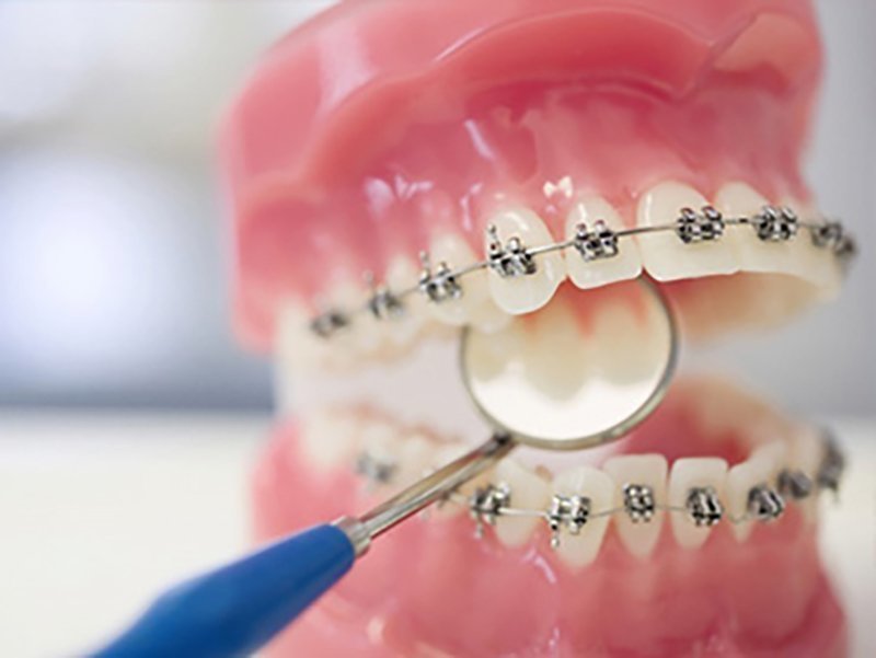 Oral Health Care and Braces Global Health Guide