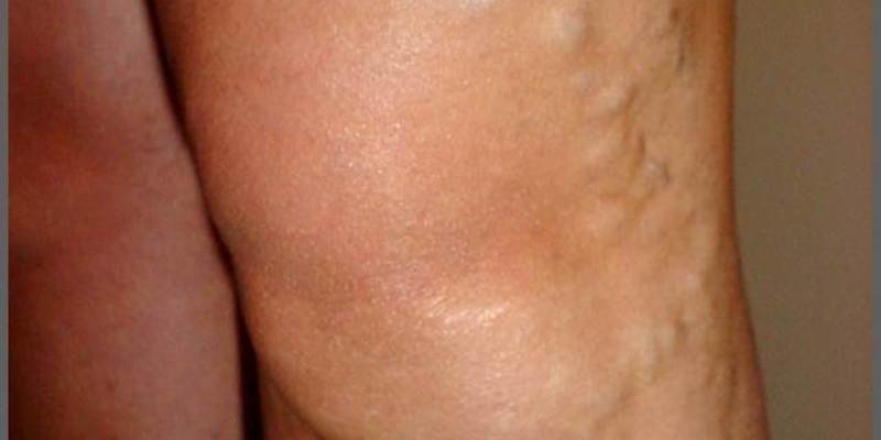 Varis Nedir? Varis Nedir?