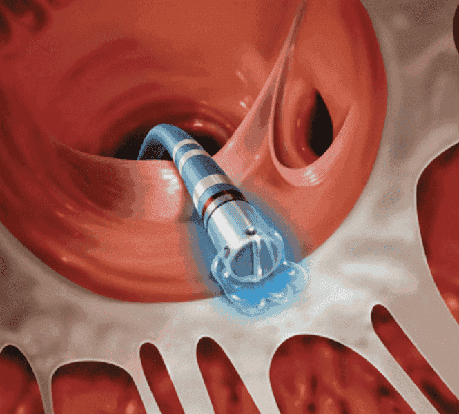 Qu’est-ce que la Fibrillation Atriale et le Traitement par Ablation ? Qu’est-ce que la Fibrillation Atriale et le Traitement par Ablation ?