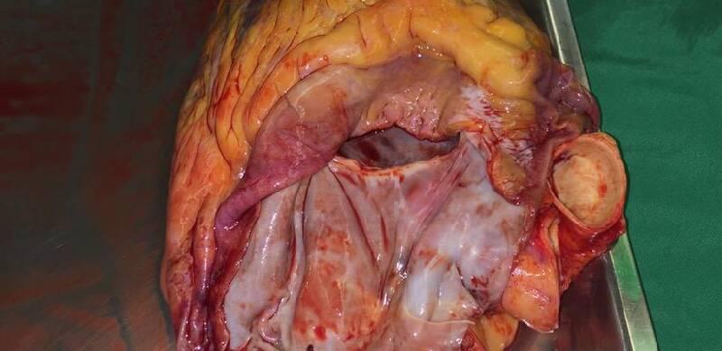 Kardiyak Ototransplantasyon (Kalbin çıkarılıp, yeniden takılması işlemi)