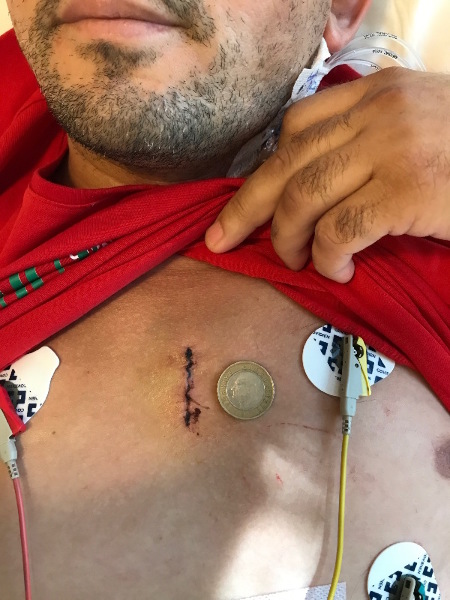 Bentall – Aortic Root Surgery with Small Incision Bentall – Aortic Root Surgery with Small Incision