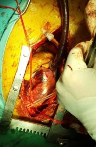 Qu’est-ce qu’un anévrisme de l’aorte (gonflement) ?