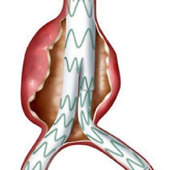 “Closed” Method Aortic Aneurysm Endovascular Stent Treatment:  “EVAR” and 