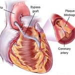 Stent mi yoksa Baypass mı ? Kalp Krizinden nasıl korunalım ?